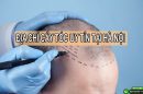 Viện Cấy tóc Quốc tế – địa chỉ cấy tóc uy tín tại Hà Nội được nhiều người nổi tiếng lựa chọn