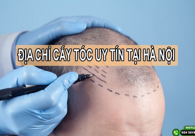 Viện Cấy tóc Quốc tế – địa chỉ cấy tóc uy tín tại Hà Nội được nhiều người nổi tiếng lựa chọn