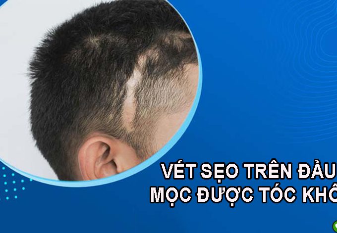 Vết sẹo trên đầu có mọc được tóc không? Bác sĩ giải đáp chi tiết