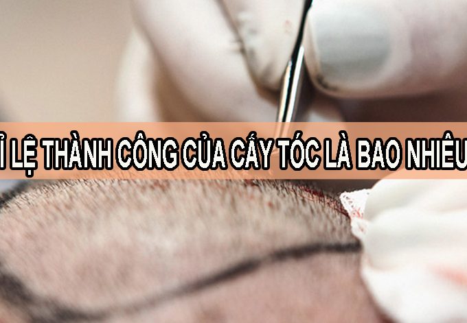 Tỷ lệ thành công của cấy tóc là bao nhiêu? Phụ thuộc vào yếu tố nào?
