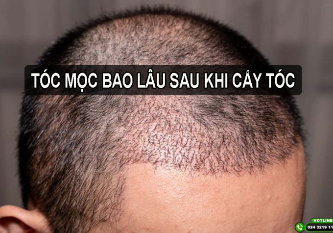 [Tìm hiểu] Tóc mọc bao lâu sau khi cấy tóc? Cách chăm sóc tóc sau cấy