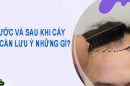 Trước và sau khi cấy tóc cần lưu ý điều gì?