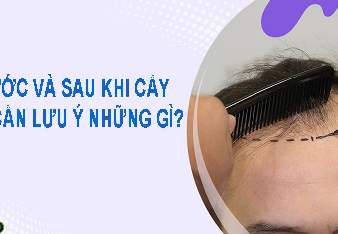 Trước và sau khi cấy tóc cần lưu ý điều gì?