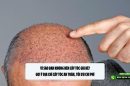 Vì sao bạn không nên cấy tóc giá rẻ? Gợi ý địa chỉ cấy tóc an toàn, tối ưu chi phí 