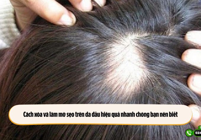 Cách xóa và làm mờ sẹo trên da đầu hiệu quả nhanh chóng bạn nên biết