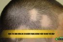 Rụng tóc hình đồng xu có nghiêm trọng không? Điều trị như thế nào? 