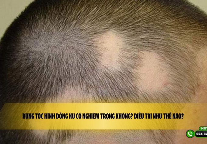 Rụng tóc hình đồng xu có nghiêm trọng không? Điều trị như thế nào? 