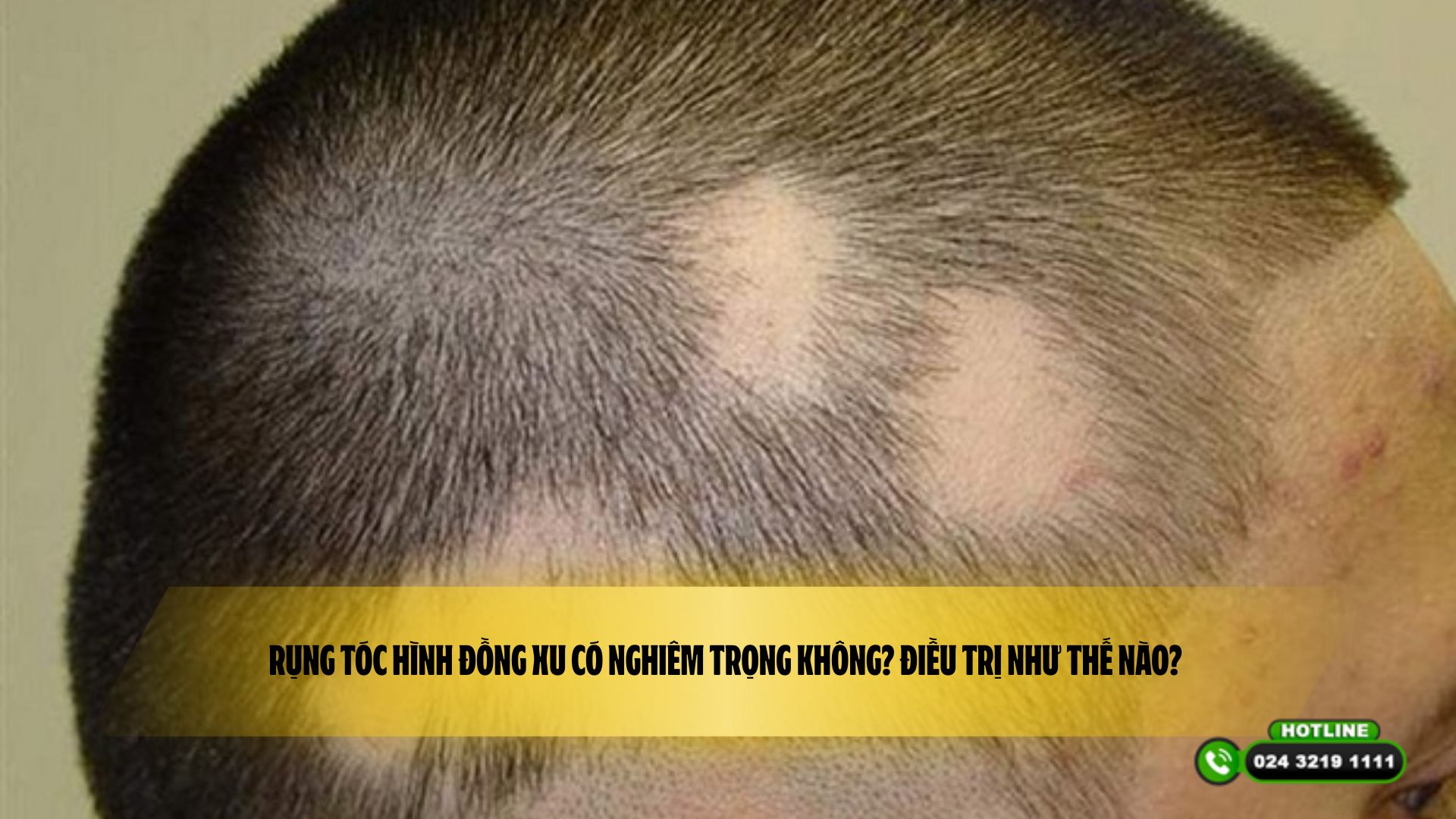 Rụng tóc hình đồng xu có nghiêm trọng không? Điều trị như thế nào? 