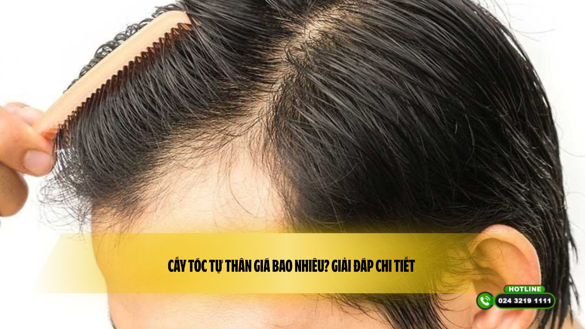 Cấy tóc tự thân giá bao nhiêu? Giải đáp chi tiết 