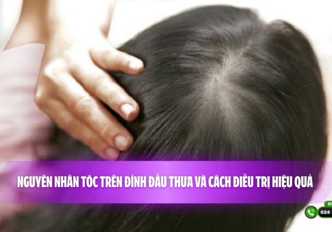 Nguyên nhân tóc trên đỉnh đầu thưa và cách điều trị hiệu quả 