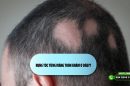 [Khám Phá] Rụng tóc từng mảng tròn khám ở đâu?