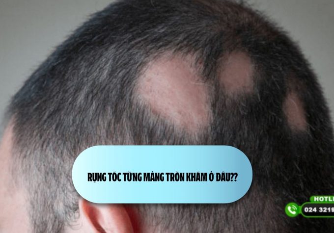 [Khám Phá] Rụng tóc từng mảng tròn khám ở đâu?