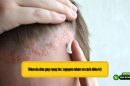 Viêm da đầu gây rụng tóc: nguyên nhân và cách điều trị 