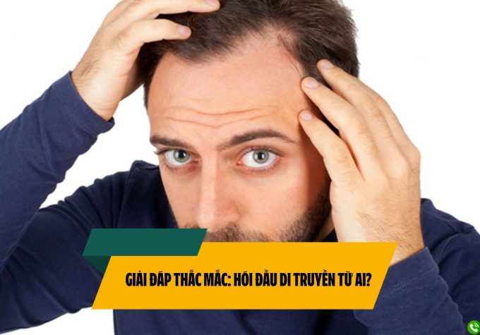 Giải đáp thắc mắc: Hói đầu di truyền từ ai?