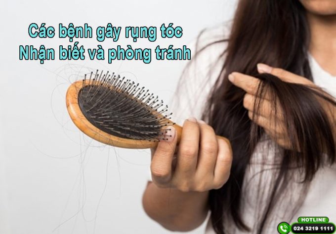 Các bệnh gây rụng tóc: Nhận biết và phòng tránh