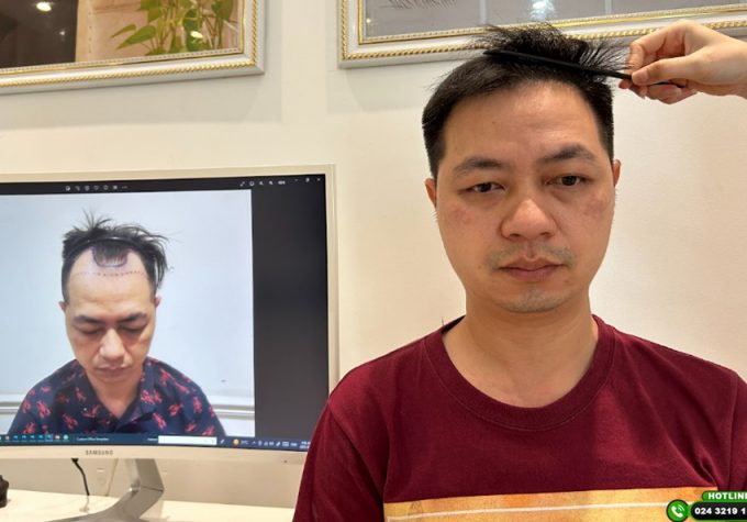 Review chi tiết hành trình cấy tóc 6 tháng: Có đáng để đầu tư?