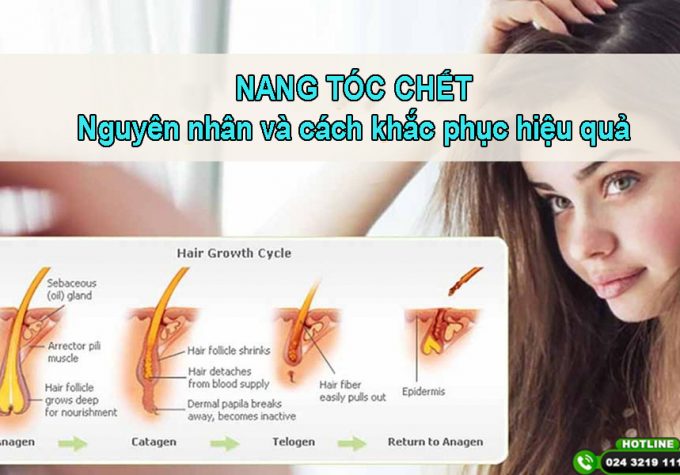 Nang tóc chết : Nguyên nhân và cách phục hồi hiệu quả