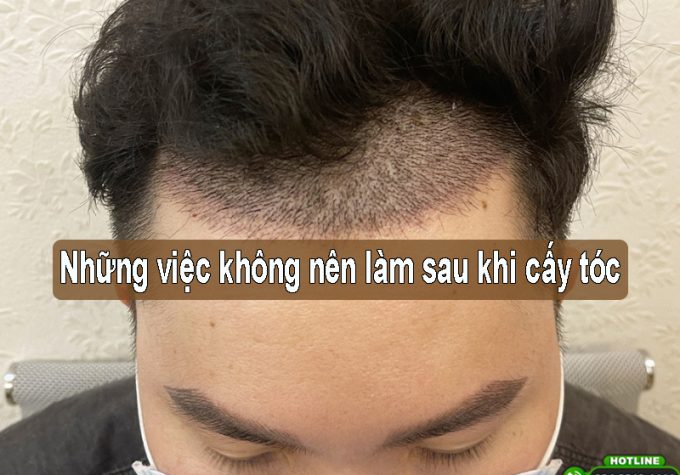 [LƯU Ý] : Những việc không nên làm sau khi cấy tóc