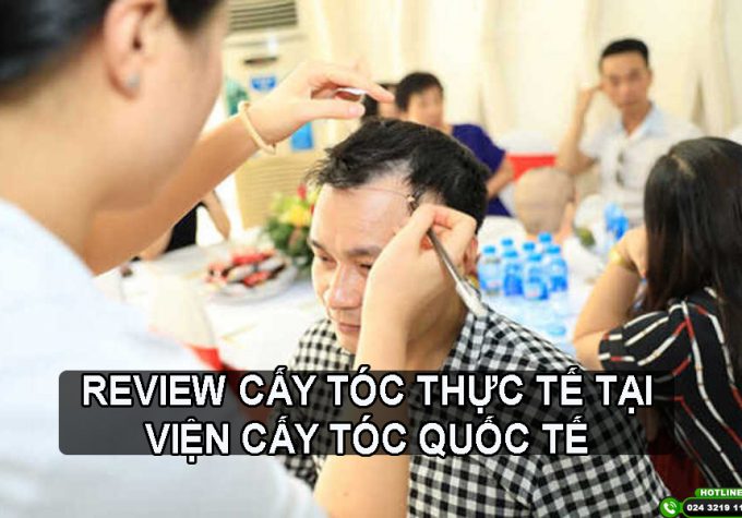 Review cấy tóc thực tế tại Viện Cấy Tóc Quốc tế: Có đáng tiền không?