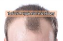 Tóc hói chữ M: Nguyên nhân và giải pháp khắc phục hiệu quả