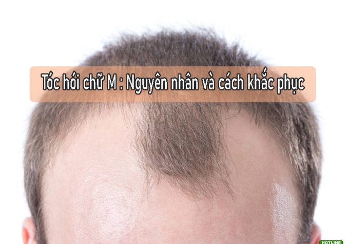 Tóc hói chữ M: Nguyên nhân và giải pháp khắc phục hiệu quả