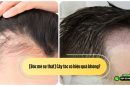[Bóc mẽ sự thật] Cấy tóc có hiệu quả không? 