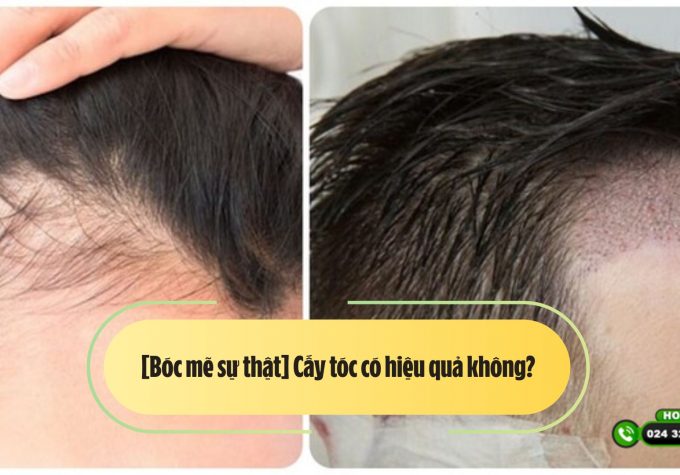 [Bóc mẽ sự thật] Cấy tóc có hiệu quả không? 