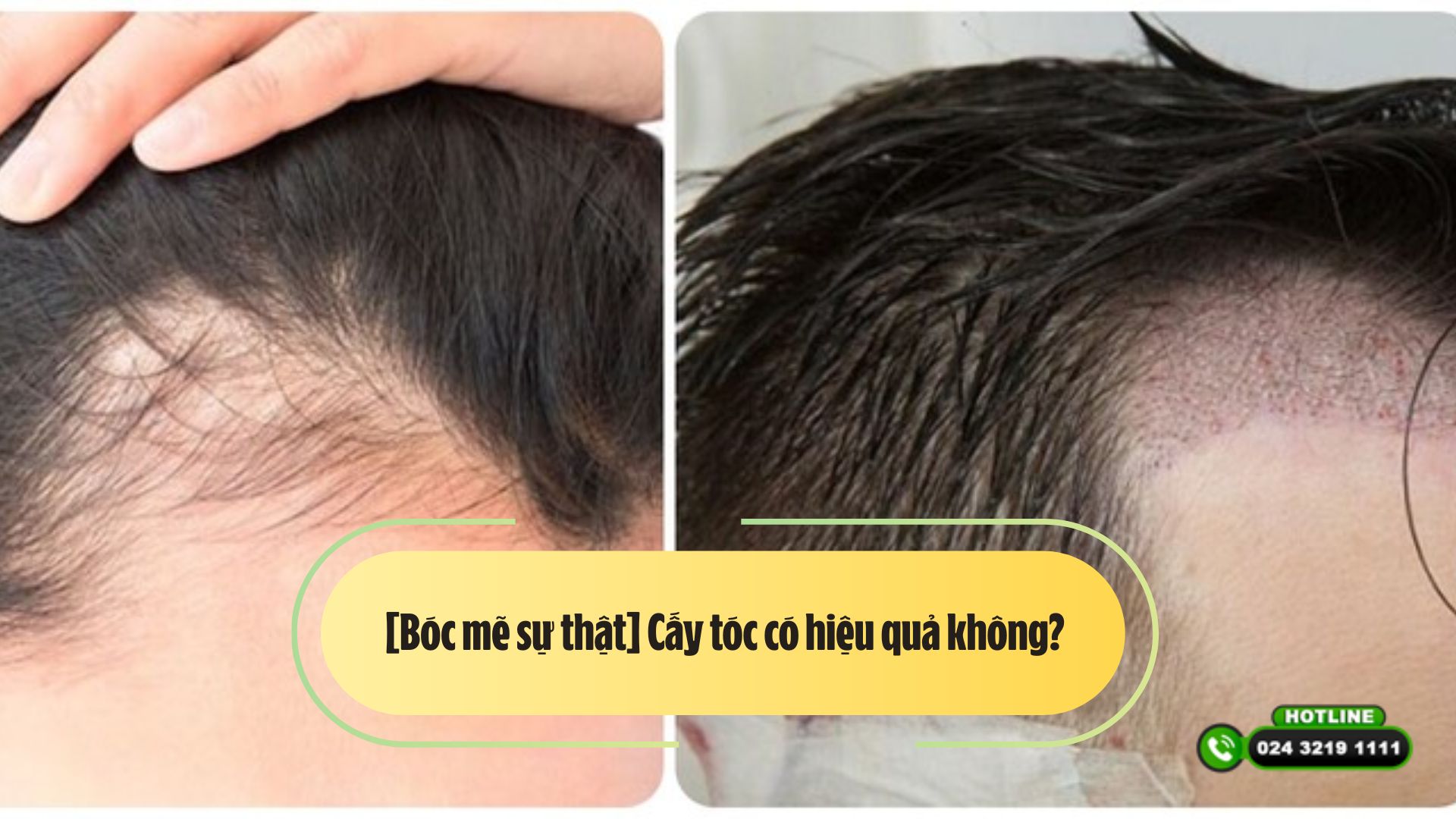 [Bóc mẽ sự thật] Cấy tóc có hiệu quả không? 
