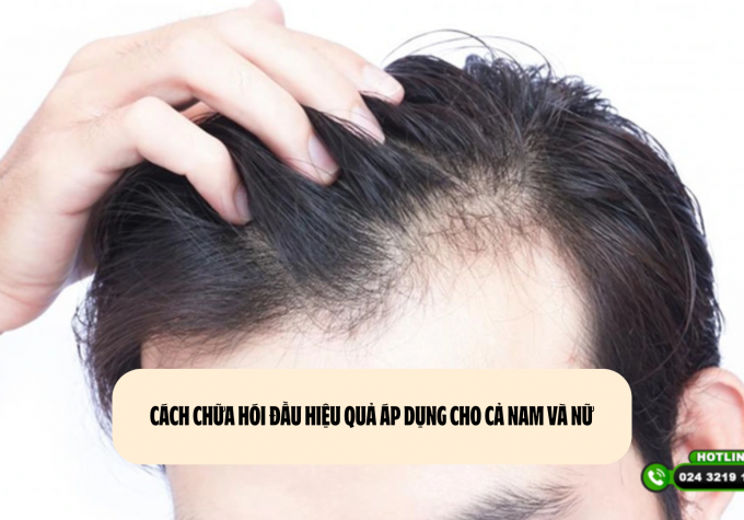 Cách chữa hói đầu hiệu quả áp dụng cho cả nam và nữ