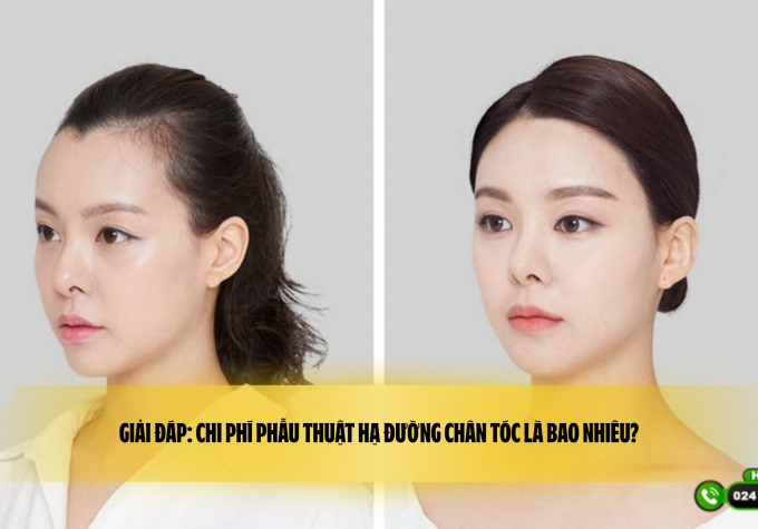 Giải đáp: Chi phí phẫu thuật hạ đường chân tóc là bao nhiêu?