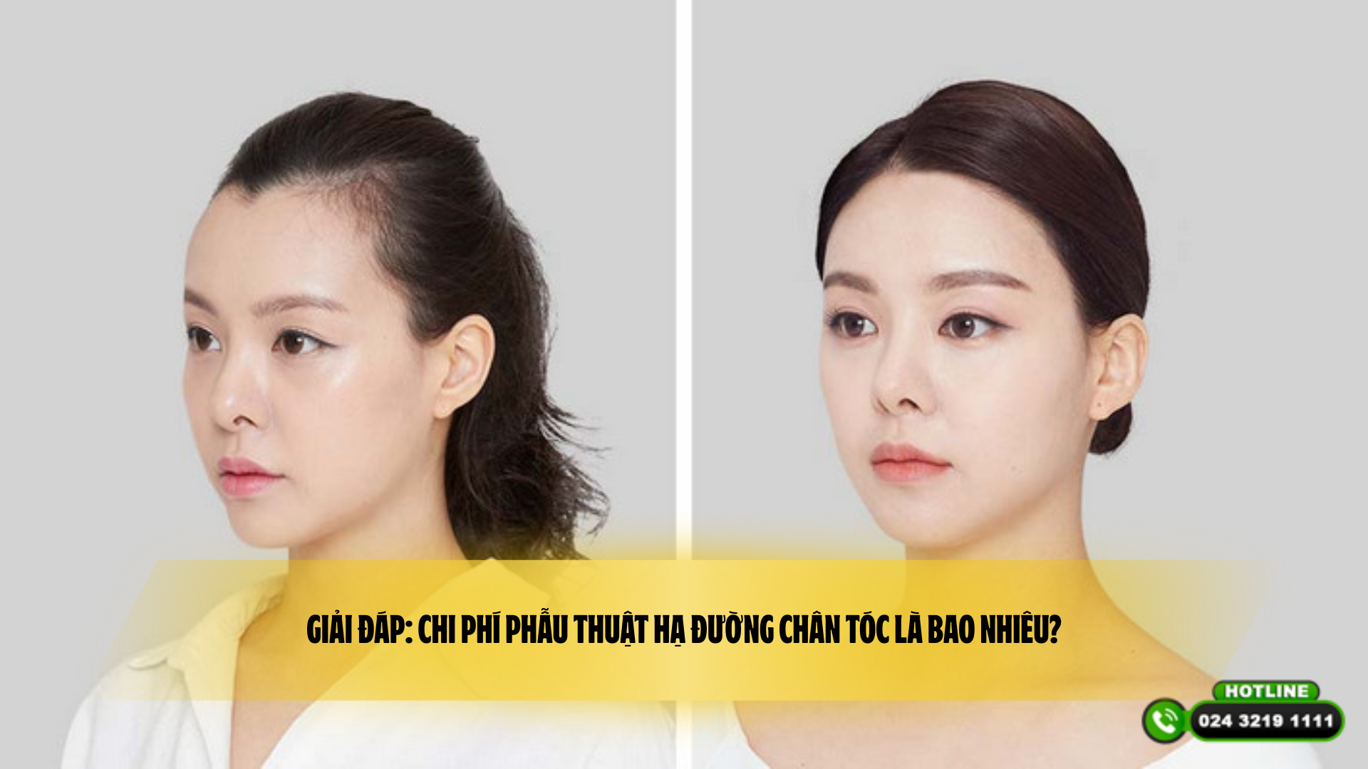 Giải đáp: Chi phí phẫu thuật hạ đường chân tóc là bao nhiêu?