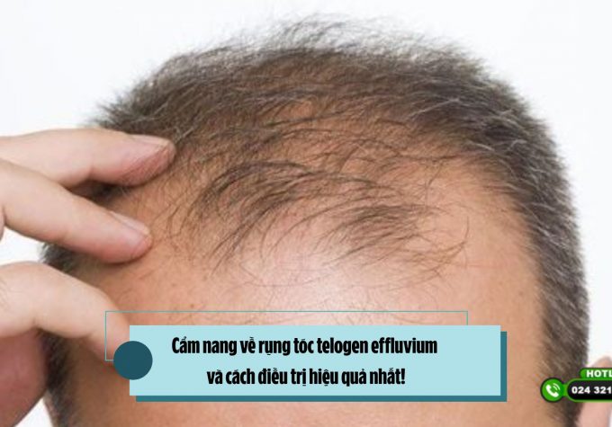 Cẩm nang về rụng tóc telogen effluvium và cách điều trị hiệu quả nhất!