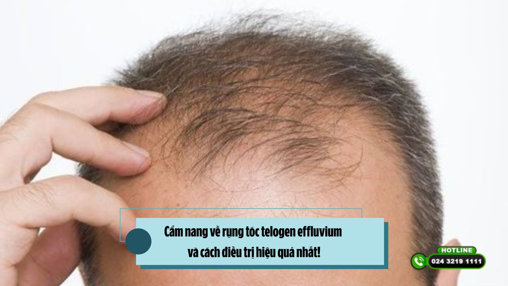 Cẩm nang về rụng tóc telogen effluvium và cách điều trị hiệu quả nhất!