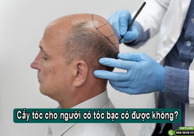 Góc tư vấn: Cấy tóc cho người có tóc bạc có được không?