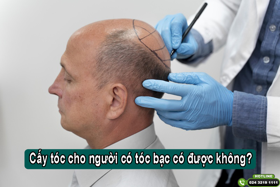 Góc tư vấn: Cấy tóc cho người có tóc bạc có được không?