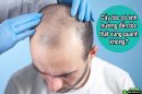 Giải đáp: Cấy tóc có ảnh hưởng đến tóc thật xung quanh không?