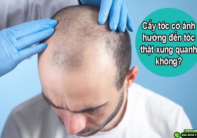 Giải đáp: Cấy tóc có ảnh hưởng đến tóc thật xung quanh không?