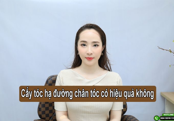 Cấy tóc hạ thấp đường chân tóc có hiệu quả không?