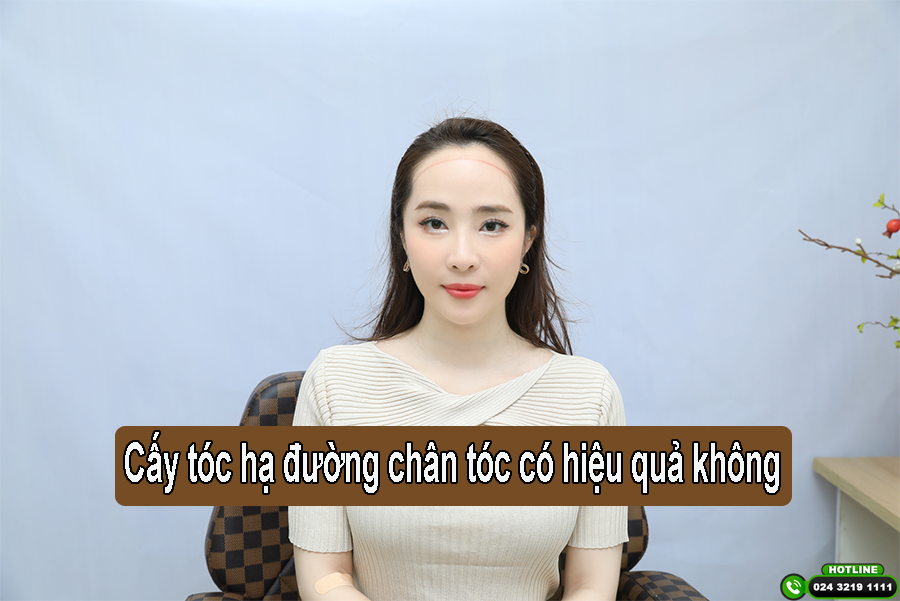 Cấy tóc hạ thấp đường chân tóc có hiệu quả không?