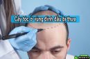 Cấy tóc ở vùng đỉnh đầu bị thưa: Quy trình, chi phí và hình ảnh thực tế