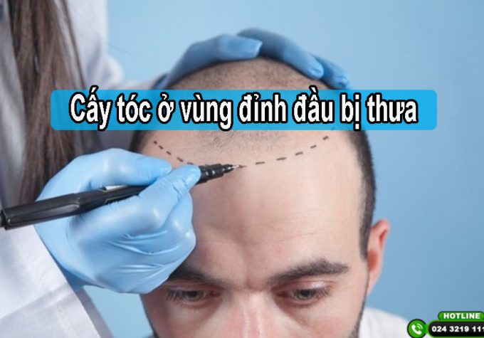 Cấy tóc ở vùng đỉnh đầu bị thưa: Quy trình, chi phí và hình ảnh thực tế