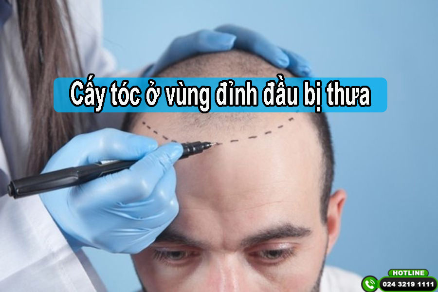 Cấy tóc ở vùng đỉnh đầu bị thưa: Quy trình, chi phí và hình ảnh thực tế