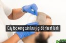 Chuyên gia giải đáp: Cấy tóc xong cần lưu ý gì để nhanh lành?