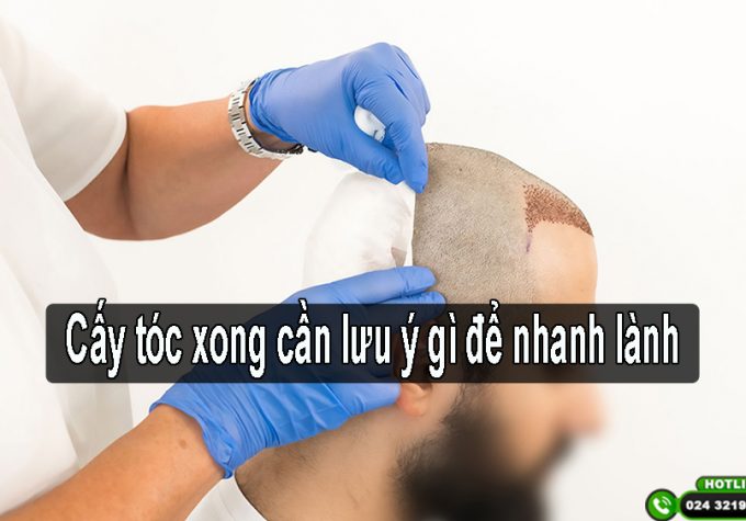 Chuyên gia giải đáp: Cấy tóc xong cần lưu ý gì để nhanh lành?