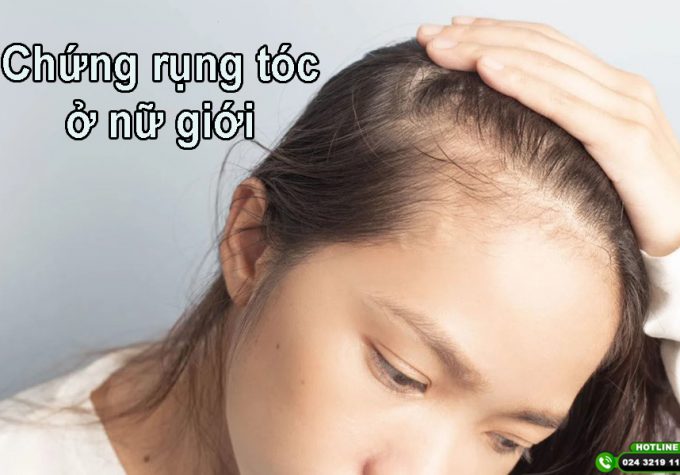 Chứng rụng tóc ở nữ giới: Những điều bạn nên biết