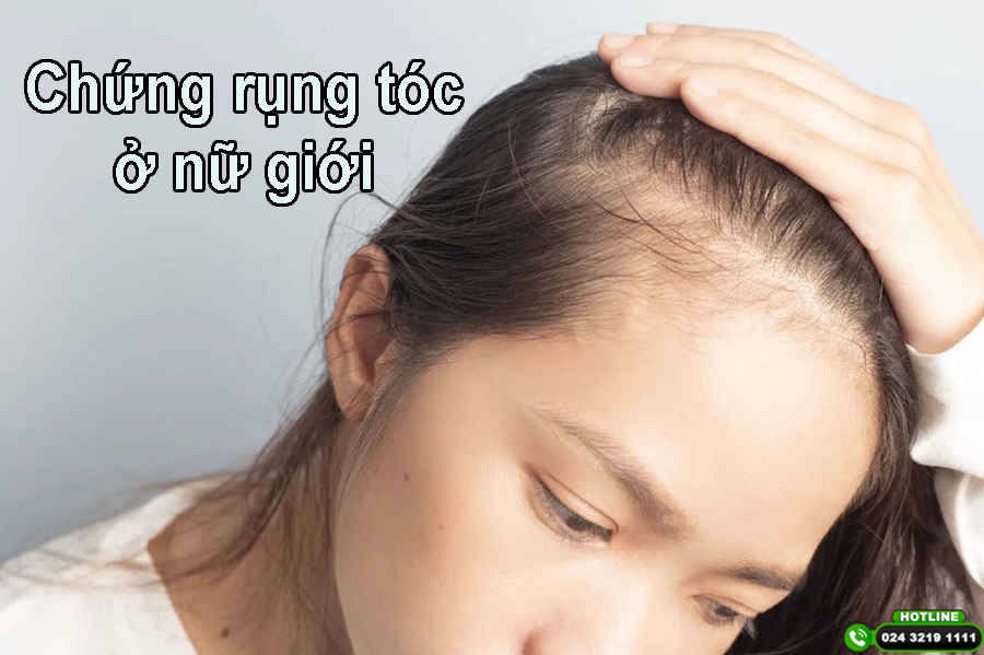 Chứng rụng tóc ở nữ giới: Những điều bạn nên biết