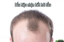 Những dấu hiệu hói đầu mà bạn cần nhận biết sớm và điều trị kịp thời