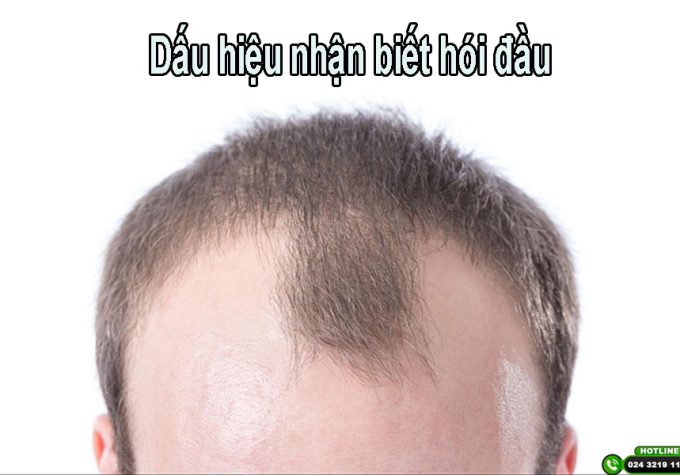Những dấu hiệu hói đầu mà bạn cần nhận biết sớm và điều trị kịp thời