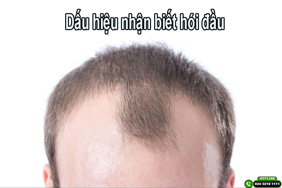 Những dấu hiệu hói đầu mà bạn cần nhận biết sớm và điều trị kịp thời