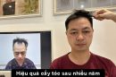 Hiệu quả của cấy tóc sau nhiều năm: Liệu có duy trì được như mong đợi?
